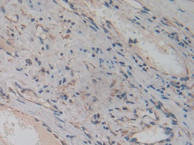 DAB staining on IHC-P; Samples: Human Prostate Gland Cancer Tissue.