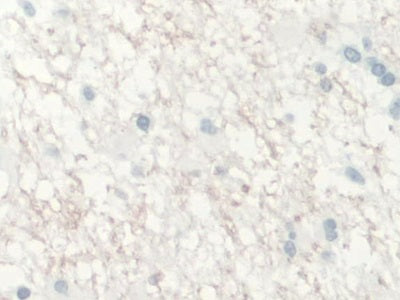 DAB staining on IHC-P; Samples: Human Glioma Tissue