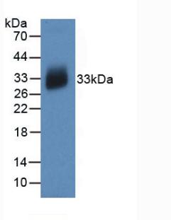 DAB staining on IHC-P; Samples: Human Stomach cancer Tissue; Primary Ab: 30µg/ml Mouse Anti-Human IL12A Antibody Second Ab: 2µg/mL HRP-Linked Caprine Anti-Mouse IgG Polyclonal Antibody