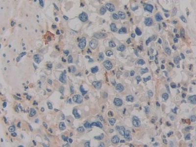 DAB staining on IHC-P; Samples: Human Stomach Cancer Tissue.
