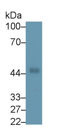 DAB staining on IHC-P; Samples: Human Glioma Tissue; Primary Ab: 30µg/ml Mouse Anti-Human PAI1 Antibody Second Ab: 2µg/mL HRP-Linked Caprine Anti-Mouse IgG Polyclonal Antibody