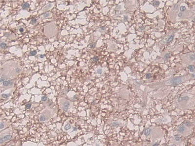 DAB staining on IHC-P; Samples: Human Glioma Tissue)