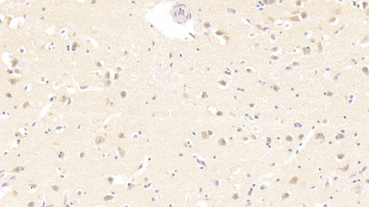 Figure. DAB staining on IHC-P; Samples: Human Prostate Gland Cancer Tissue.
