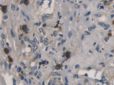 DAB staining on IHC-P; Samples: Human Pancreatic cancer Tissue;  Primary Ab: 20µg/ml Mouse Anti-Huma