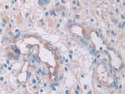 DAB staining on IHC-P; Samples: Human Glioma Tissue)