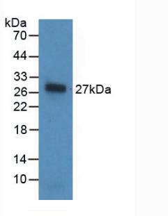 DAB staining on IHC-P; Samples: Human Liver cancer Tissue; Primary Ab: 30µg/ml Mouse Anti-Human NOG Antibody Second Ab: 2µg/mL HRP-Linked Caprine Anti-Mouse IgG Polyclonal Antibody