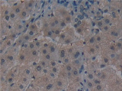 DAB staining on IHC-P; Samples: Human Liver cancer Tissue)