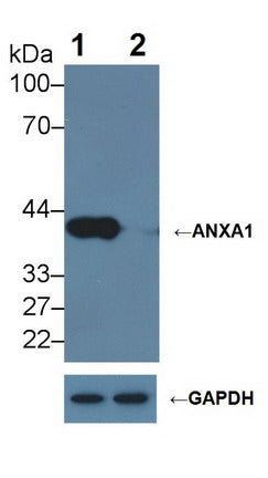 DAB staining on IHC-P; Samples: Human Breast cancer Tissue; Primary Ab: 10µg/ml Mouse Anti-Human ANXA1 Antibody Second Ab: 2µg/mL HRP-Linked Caprine Anti-Mouse IgG Polyclonal Antibody