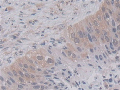 DAB staining on IHC-P; Samples: Human Lung cancer Tissue)