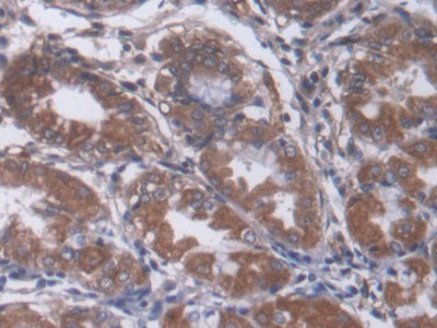 DAB staining on IHC-P; Samples: Human Liver cancer Tissue;  Primary Ab: 20µg/ml Mouse Anti-Human a2M