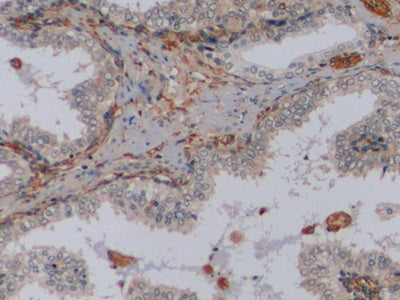DAB staining on IHC-P; Samples: Human Endometrial cancer Tissue; Primary Ab: 10µg/ml Mouse Anti-Human VIM Antibody Second Ab: 2µg/mL HRP-Linked Caprine Anti-Mouse IgG Polyclonal Antibody