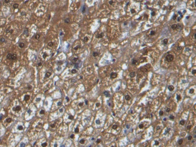 DAB staining on IHC-P; Samples: Human Liver cancer Tissue; Primary Ab: 10µg/ml Mouse Anti-Human Arg Antibody Second Ab: 2µg/mL HRP-Linked Caprine Anti-Mouse IgG Polyclonal Antibody