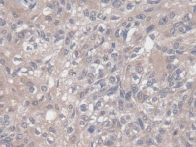 DAB staining on IHC-P; Samples: Human Thyroid Cancer Tissue
