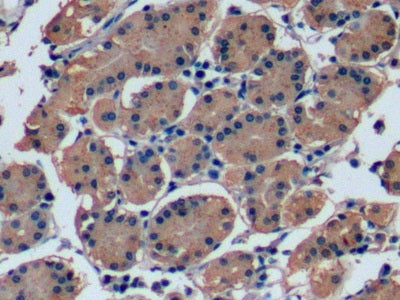 DAB staining on IHC-P; Samples: Human Liver cancer Tissue;  Primary Ab: 10µg/ml Mouse Anti-Human FGF