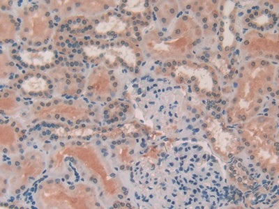 DAB staining on IHC-P; Samples: Human Thyroid Cancer Tissue.
