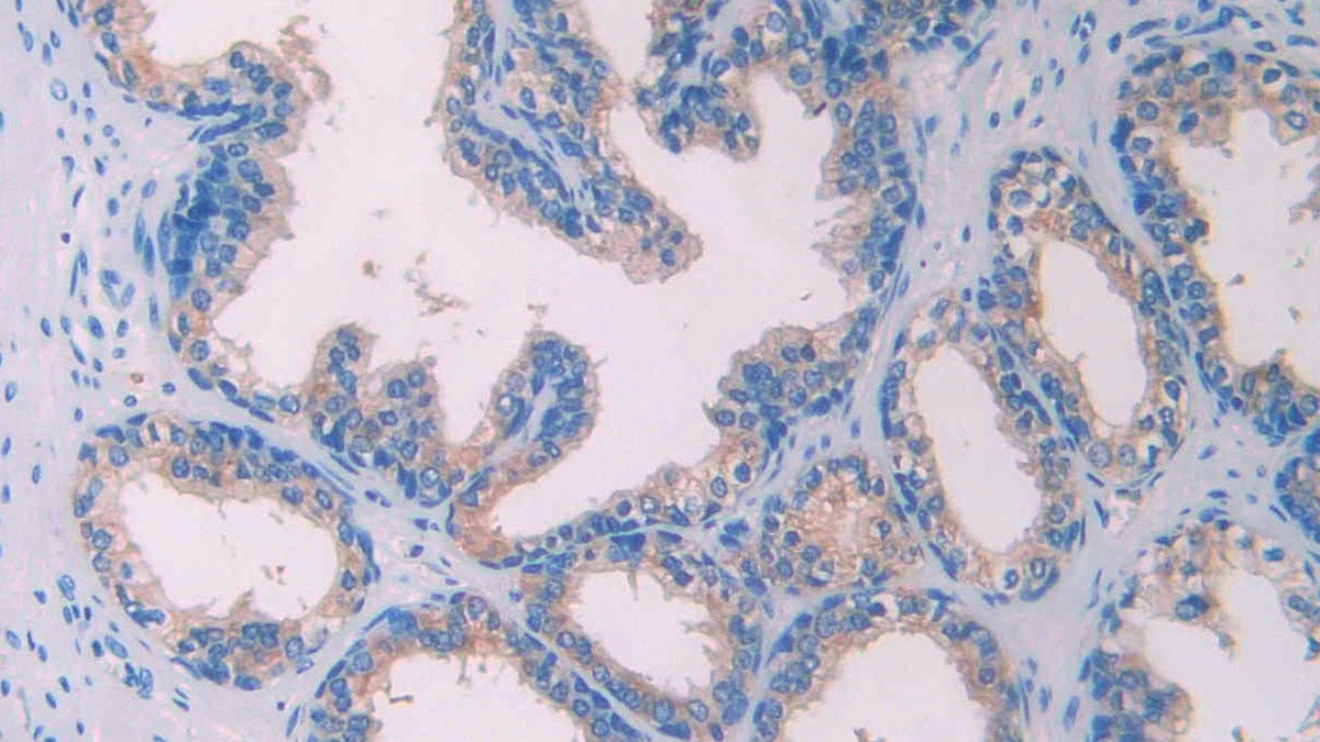 DAB staining on IHC-P; Samples: Human Liver cancer Tissue; Primary Ab: 40µg/ml Mouse Anti-Fish AMH Antibody Second Ab: 2µg/mL HRP-Linked Caprine Anti-Mouse IgG Polyclonal Antibody