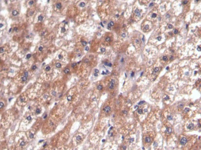 DAB staining on IHC-P; Samples: Human Ovarian cancer Tissue; Primary Ab: 20µg/ml Mouse Anti-Human aFP Antibody Second Ab: 2µg/mL HRP-Linked Caprine Anti-Mouse IgG Polyclonal Antibody