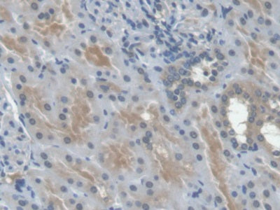DAB staining on IHC-P; Samples: Human Thyroid cancer Tissue; Primary Ab: 30µg/ml Mouse Anti-Human EPO Antibody Second Ab: 2µg/mL HRP-Linked Caprine Anti-Mouse IgG Polyclonal Antibody