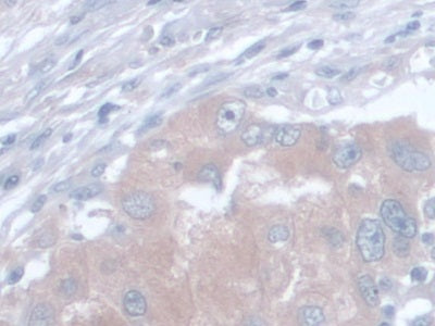 DAB staining on IHC-P; Samples: Human Glioma Tissue; Primary Ab: 30µg/ml Mouse Anti-Human AST Antibody Second Ab: 2µg/mL HRP-Linked Caprine Anti-Mouse IgG Polyclonal Antibody