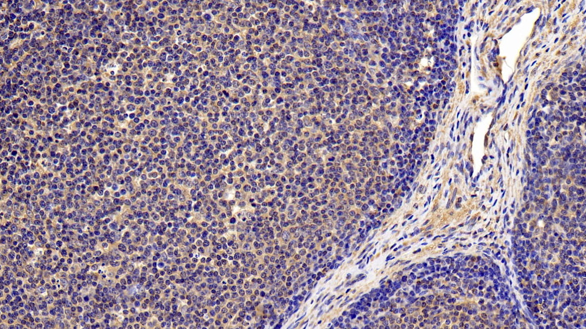 DAB staining on IHC-P; Sample: Human Stomach cancer Tissue; Primary Ab: 10ug/ml Rabbit Anti-Human IL4R Antibody Second Ab: 2µg/mL HRP-Linked Caprine Anti-Rabbit IgG Polyclonal Antibody