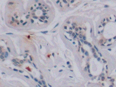 DAB staining on IHC-P; Samples: Human Liver cancer Tissue; Primary Ab: 10µg/ml Mouse Anti-Human VEGF165 Antibody Second Ab: 2µg/mL HRP-Linked Caprine Anti-Mouse IgG Polyclonal Antibody