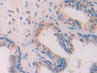 DAB staining on IHC-P; Samples: Human Glioma Tissue; Primary Ab: 30µg/ml Mouse Anti-Multi-species Ab1-42 Antibody Second Ab: 2µg/mL HRP-Linked Caprine Anti-Mouse IgG Polyclonal Antibody