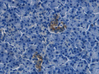 DAB staining on IHC-P; Samples: Human Glioma Tissue; Primary Ab: 20µg/ml Mouse Anti-Human EDN1 Antibody Second Ab: 2µg/mL HRP-Linked Caprine Anti-Mouse IgG Polyclonal Antibody