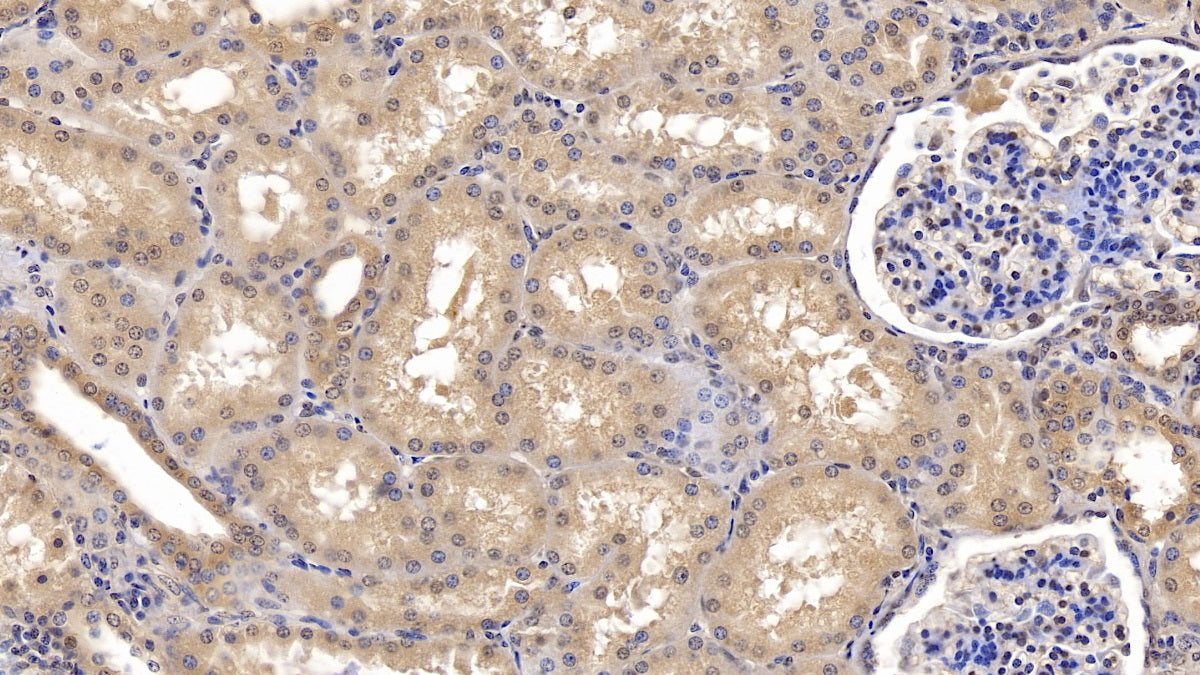DAB staining on IHC-P; Samples: Human Liver cancer Tissue; Primary Ab: 10µg/ml Mouse Anti-Multi-species Ub Antibody Second Ab: 2µg/mL HRP-Linked Caprine Anti-Mouse IgG Polyclonal Antibody