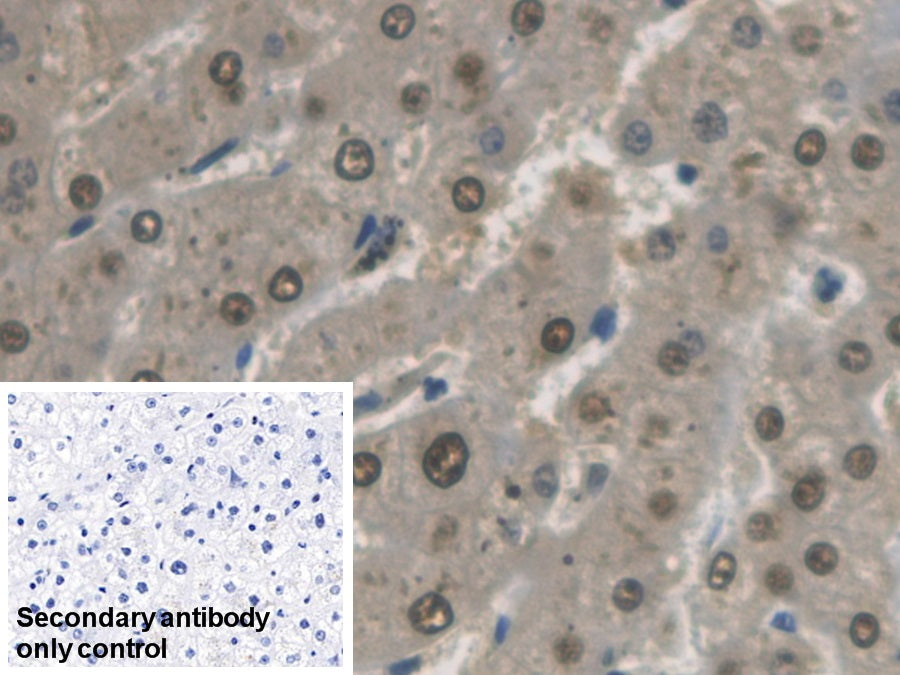 DAB staining on IHC-P; Sample: Human Liver cancer Tissue; Primary Ab: 30ug/ml Mouse Anti-Human GAPDH Antibody; Control: Used PBS instead of primary antibody; Second Ab: 2ug/ml HRP-Linked Caprine Anti-Mouse IgG Polyclonal Antibody