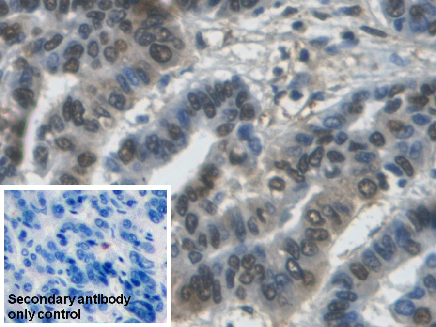 DAB staining on IHC-P; Sample: Human Thyroid cancer Tissue; Primary Ab: 30ug/ml Mouse Anti-Human GAPDH Antibody; Control: Used PBS instead of primary antibody; Second Ab: 2ug/ml HRP-Linked Caprine Anti-Mouse IgG Polyclonal Antibody