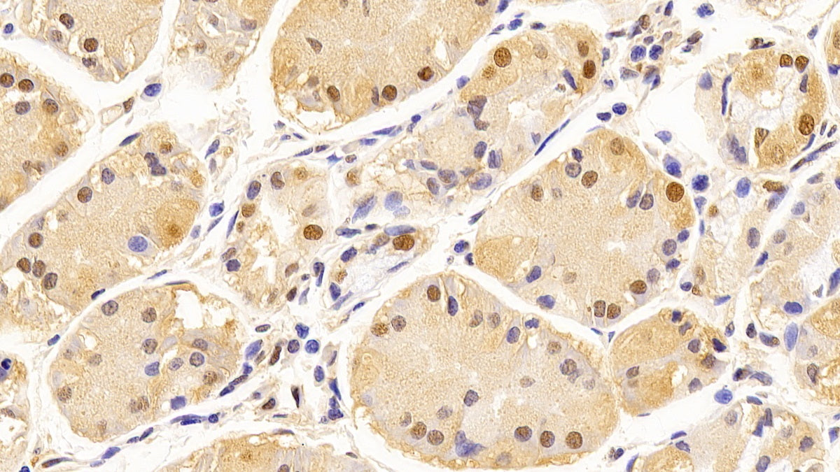 DAB staining on IHC-P; Sample: Human Endometrial cancer Tissue; Primary Ab: 10ug/ml Mouse Anti-Human GAPDH Antibody; Second Ab: 2ug/mL HRP-Linked Caprine Anti-Mouse IgG Polyclonal Antibody