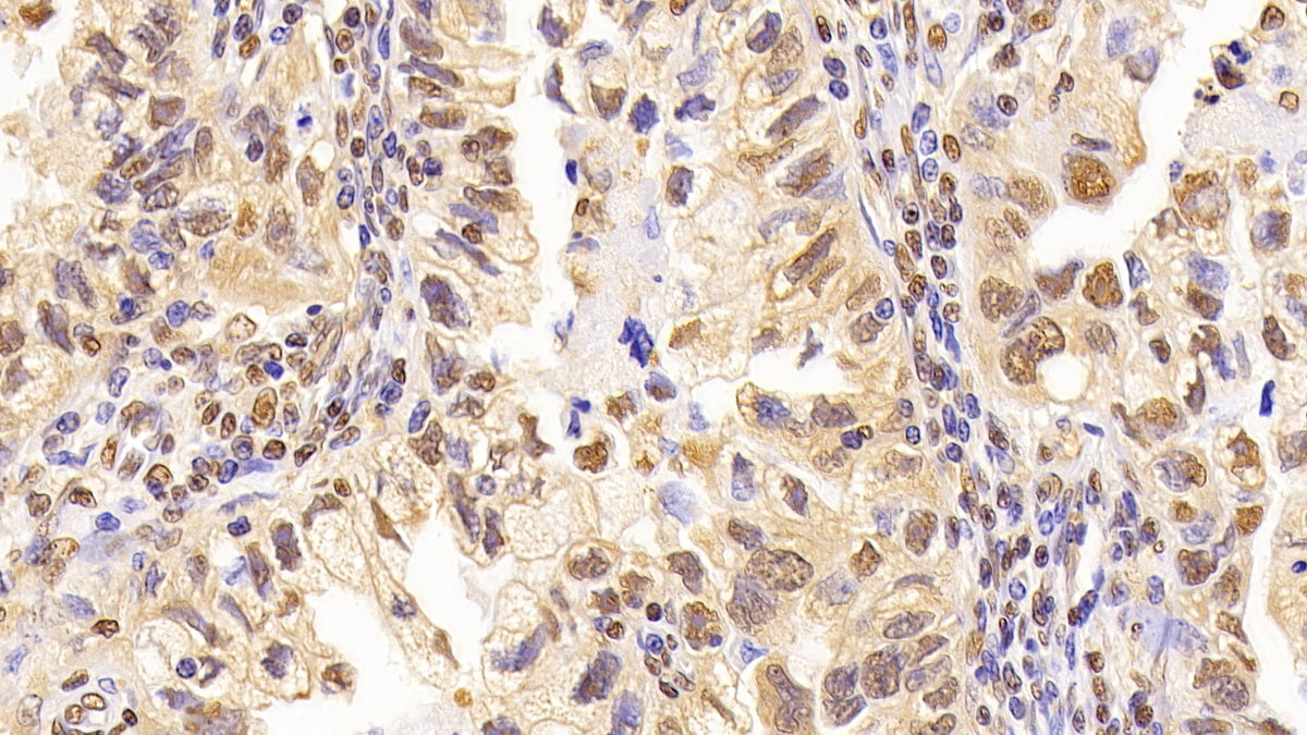 DAB staining on IHC-P; Sample: Human Colorectal cancer Tissue; Primary Ab: 10ug/ml Mouse Anti-Human GAPDH Antibody; Second Ab: 2ug/mL HRP-Linked Caprine Anti-Mouse IgG Polyclonal Antibody