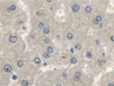 DAB staining on IHC-P; Samples: Human Lung cancer Tissue; Primary Ab: 20ug/ml Rabbit Anti-Human ErbB4 Antibody; Second Ab: 2ug/mL HRP-Linked Caprine Anti-Rabbit IgG Polyclonal Antibody