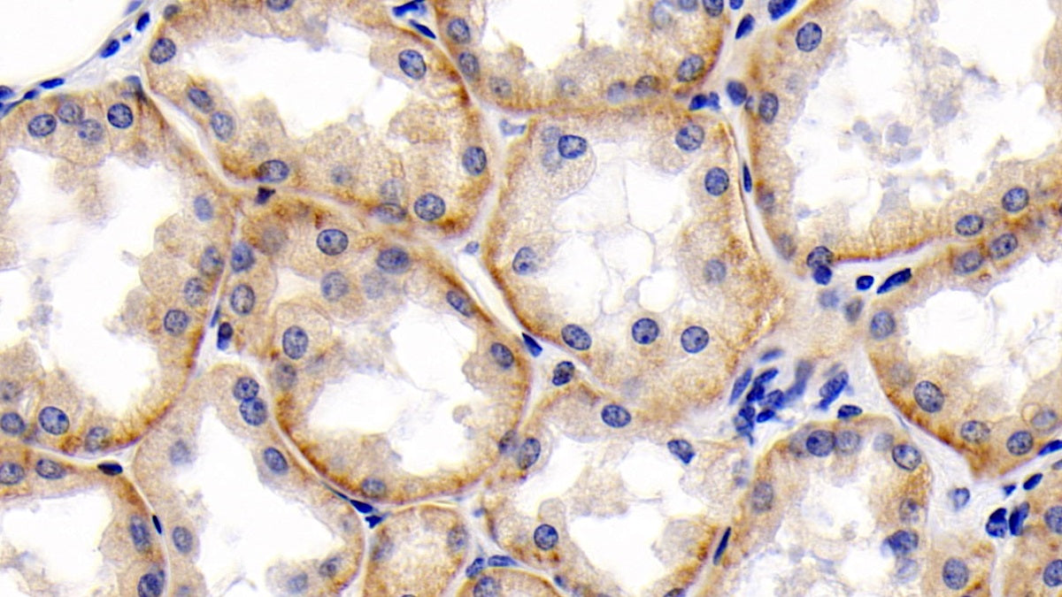 DAB staining on IHC-P; Sample: Human Stomach cancer Tissue; Primary Ab: 30ug/ml Mouse Anti-Human CD147 Antibody; Second Ab: 2ug/mL HRP-Linked Caprine Anti-Mouse IgG Polyclonal Antibody