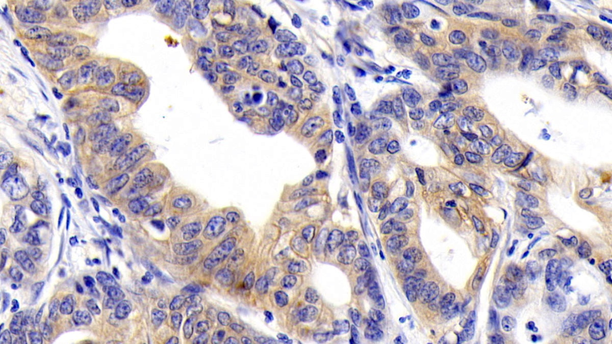 DAB staining on IHC-P; Sample: Human Liver cancer Tissue; Primary Ab: 30ug/ml Mouse Anti-Human CD147 Antibody; Second Ab: 2ug/mL HRP-Linked Caprine Anti-Mouse IgG Polyclonal Antibody