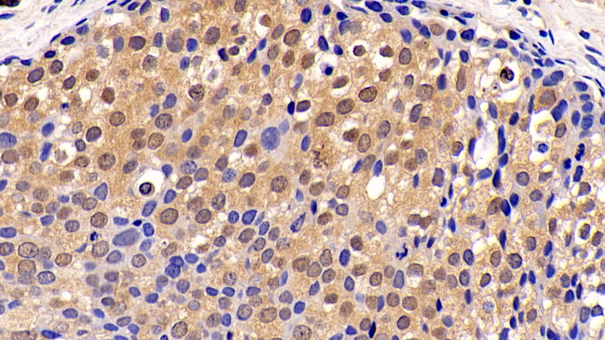 DAB staining on IHC-P; Sample: Human Colon Tissue; Primary Ab: 20ug/ml Mouse Anti-Human ERK1 Antibody; Second Ab: 2ug/mL HRP-Linked Caprine Anti-Mouse IgG Polyclonal Antibody