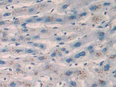 DAB staining on IHC-P; Samples: Human Liver cancer Tissue; Primary Ab: 40ug/ml Mouse Anti-Multi-species Ang1-7 Antibody; Second Ab: 2ug/mL HRP-Linked Caprine Anti-Mouse IgG Polyclonal Antibody