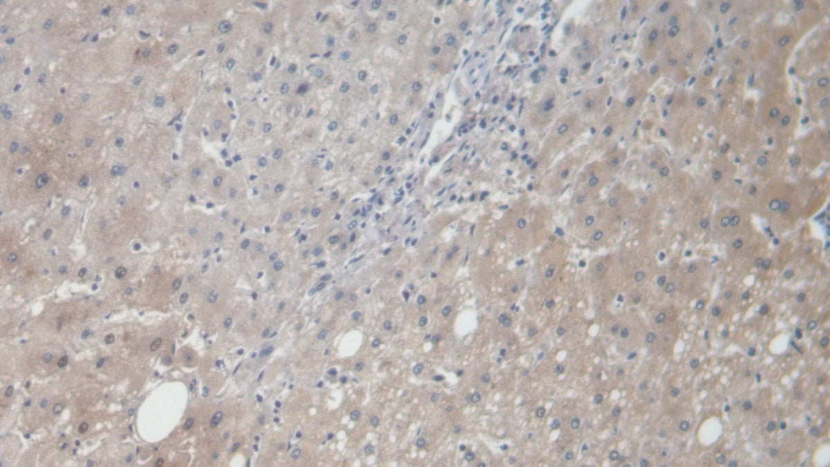 DAB staining on IHC-P; Samples: Human Liver Cancer Tissue; Primary Ab: 20ug/ml Rabbit Anti-Multi-species AngI Antibody; Second Ab: 2ug/mL HRP-Linked Caprine Anti-Rabbit IgG Polyclonal Antibody