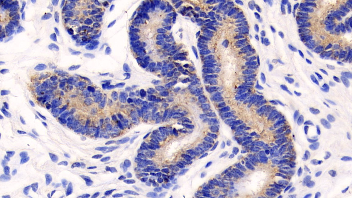 DAB staining on IHC-P; Sample: Human Kidney Tissue; Primary Ab: 40ug/ml Mouse Anti-Human MMP13 Antibody; Second Ab: 2ug/mL HRP-Linked Caprine Anti-Mouse IgG Polyclonal Antibody