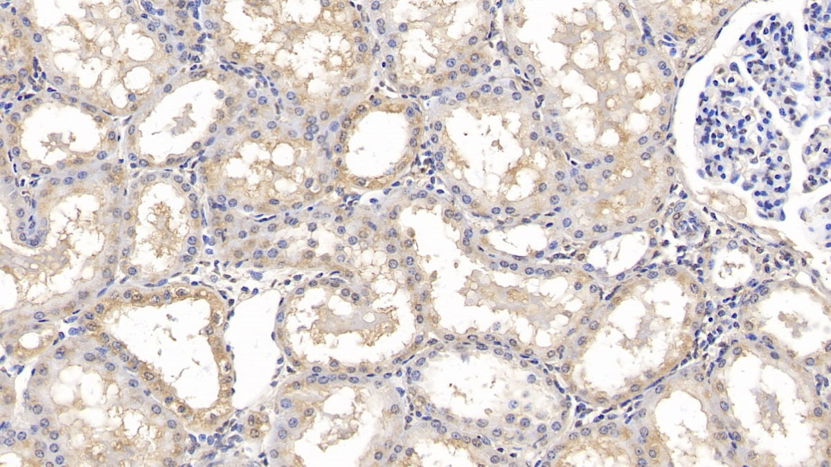 DAB staining on IHC-P; Sample: Human Liver Tissue; Primary Ab: 40ug/ml Mouse Anti-Human MMP13 Antibody; Second Ab: 2ug/mL HRP-Linked Caprine Anti-Mouse IgG Polyclonal Antibody