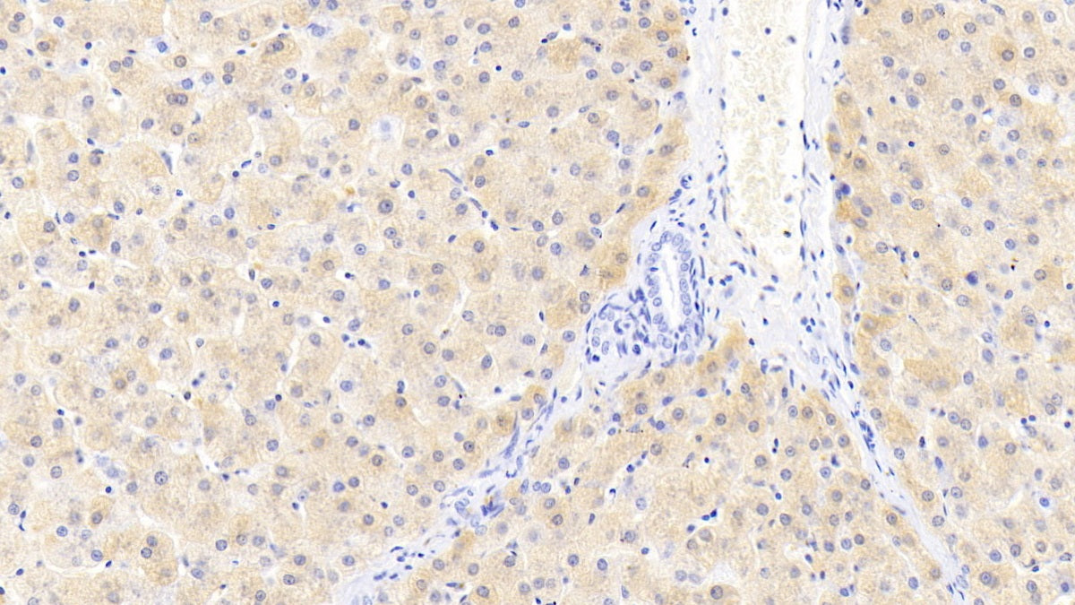 DAB staining on IHC-P; Sample: Human Liver Tissue; Primary Ab: 20ug/ml Mouse Anti-Human FTL Antibody; Control: Used PBS instead of primary antibody; Second Ab: 2ug/ml HRP-Linked Caprine Anti-Mouse IgG Polyclonal Antibody