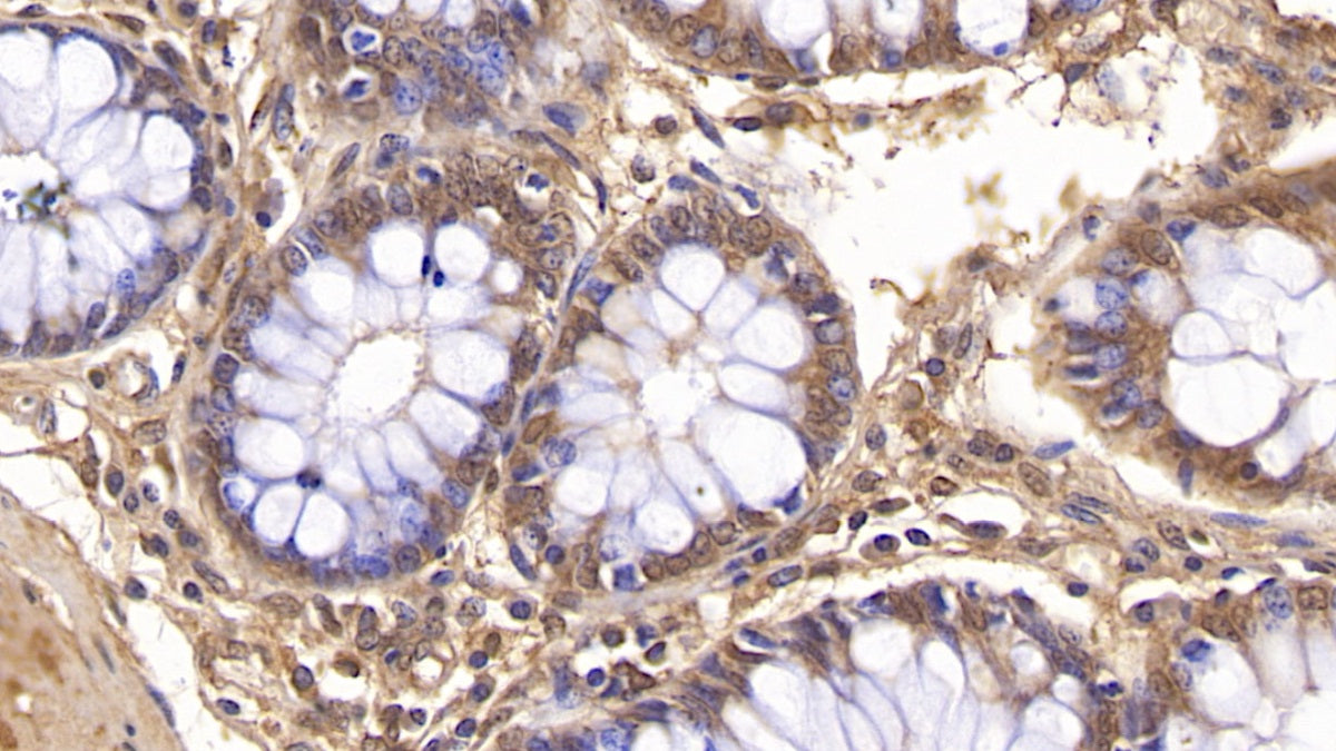 DAB staining on IHC-P; Sample: Human Colon Tissue; Primary Ab: 20ug/ml Mouse Anti-Human VF Antibody; Control: Used PBS instead of primary antibody; Second Ab: 2ug/ml HRP-Linked Caprine Anti-Mouse IgG Polyclonal Antibody