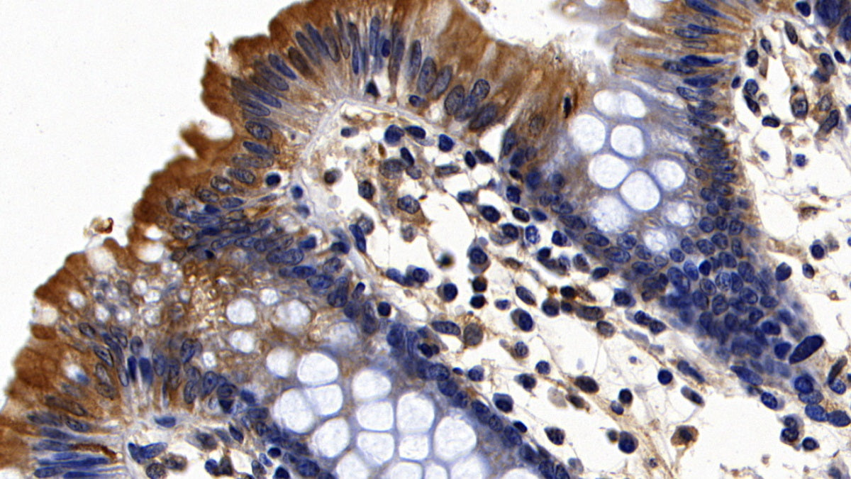 DAB staining on IHC-P; Sample: Human Colorectal cancer Tissue; Primary Ab: 10ug/ml Rabbit Anti-Human PTPN1 Antibody; Second Ab: 2ug/mL HRP-Linked Caprine Anti-Rabbit IgG Polyclonal Antibody