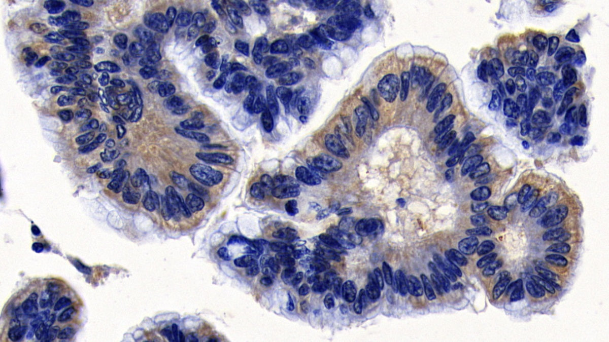 DAB staining on IHC-P; Sample: Human Stomach cancer Tissue; Primary Ab: 10ug/ml Rabbit Anti-Human PTPN1 Antibody; Second Ab: 2ug/mL HRP-Linked Caprine Anti-Rabbit IgG Polyclonal Antibody