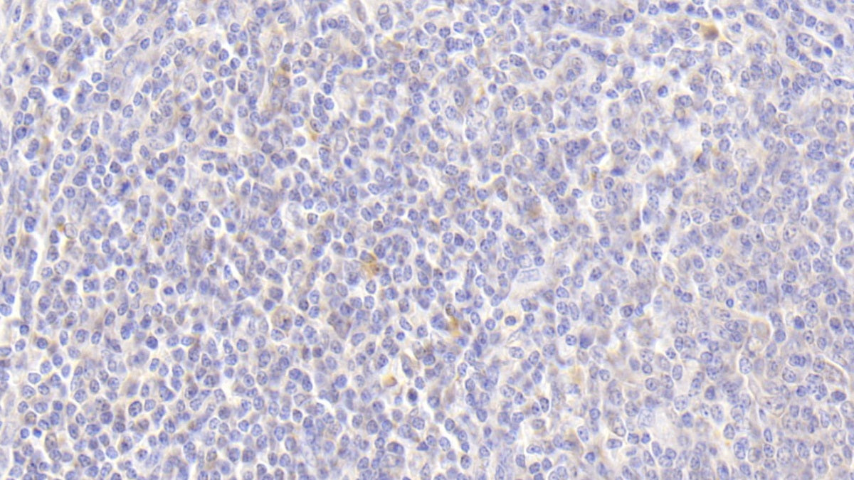 DAB staining on IHC-P; Sample: Human Liver Tissue; Primary Ab: 20ug/ml Mouse Anti-Human a1AT Antibody; Second Ab: 2ug/mL HRP-Linked Caprine Anti-Mouse IgG Polyclonal Antibody