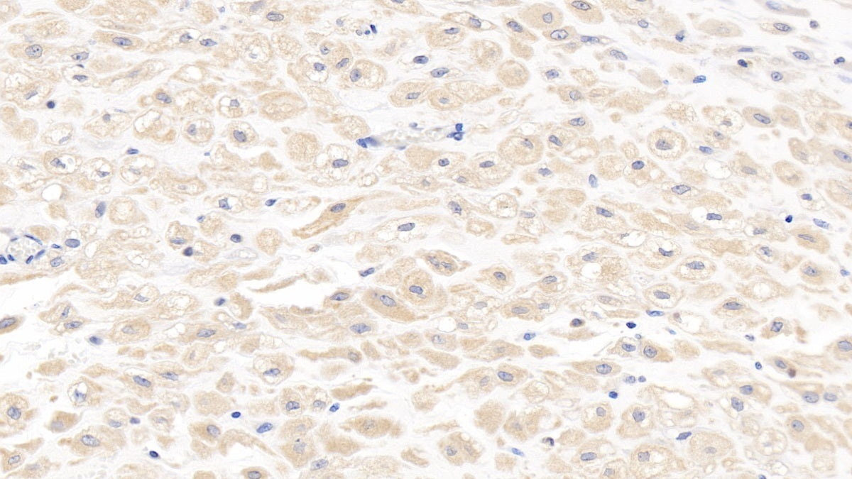 DAB staining on IHC-P; Sample: Human Kidney Tissue; Primary Ab: 20ug/ml Mouse Anti-Human MMP8 Antibody; Second Ab: 2ug/mL HRP-Linked Caprine Anti-Mouse IgG Polyclonal Antibody