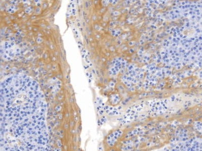 DAB staining on IHC-P; Sample: Human Lung cancer Tissue; Primary Ab: 10ug/ml Mouse Anti-Human KRT17 Antibody; Second Ab: 2ug/mL HRP-Linked Caprine Anti-Mouse IgG Polyclonal Antibody