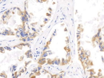 DAB staining on IHC-P; Sample: Human Breast cancer Tissue; Primary Ab: 10ug/ml Mouse Anti-Human KRT17 Antibody; Second Ab: 2ug/mL HRP-Linked Caprine Anti-Mouse IgG Polyclonal Antibody