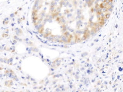 DAB staining on IHC-P; Sample: Human Kidney Tissue; Primary Ab: 10ug/ml Mouse Anti-Human KRT17 Antibody; Second Ab: 2ug/mL HRP-Linked Caprine Anti-Mouse IgG Polyclonal Antibody