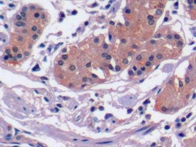 DAB staining on IHC-P; Sample: Human Liver cancer Tissue; Primary Ab: 10ug/ml Mouse Anti-Human aFP Antibody; Second Ab: 2ug/mL HRP-Linked Caprine Anti-Mouse IgG Polyclonal Antibody